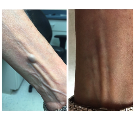 Consultants In Cardiology-Electrophysiology-Cce Vein-VSCLR - Oak Lawn, IL. Before and after