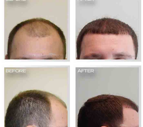 Natural Transplant, Hair Restoration Clinic MIAMI - Miami, FL