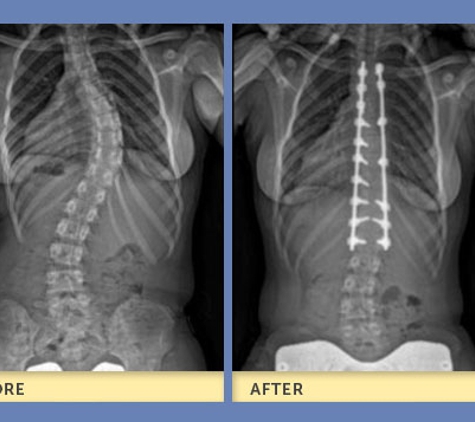 Michael G Vitale, MD - New York, NY. Scoliosis Surgery