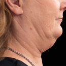 Blue Grass Aesthetics - Reducing & Weight Control
