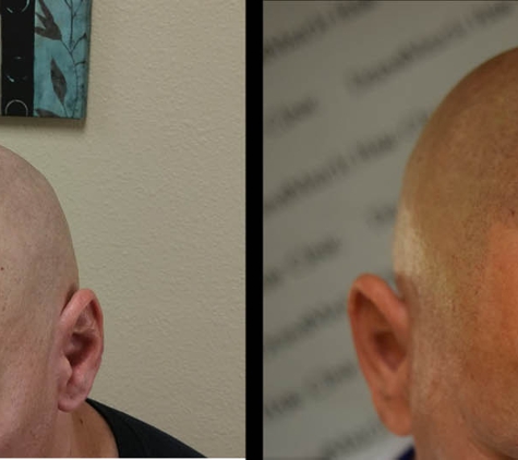 DermiMatch Hair Clinic - SMP (scalp micropigmentation) - Phoenix, AZ