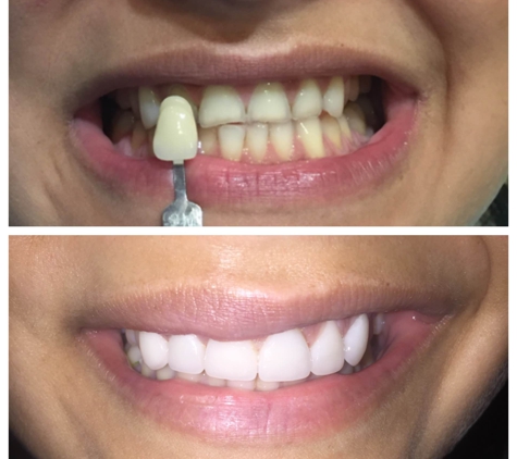 Roach Family Dentistry - Nashville, TN. Before & After