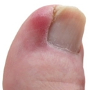 Ingrown Toenail Therapy - Physicians & Surgeons, Podiatrists