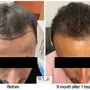 West LA Hair Restoration