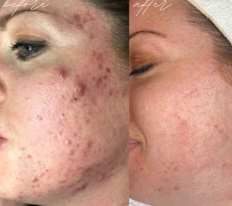 Crystal Skin Care - Kaysville, UT. Acne Treatment: Before and After