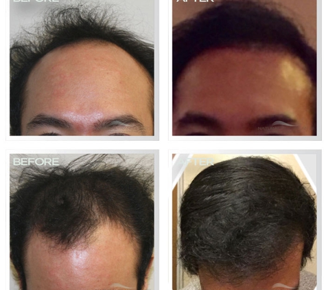 Natural Transplant, Hair Restoration Clinic MIAMI - Miami, FL