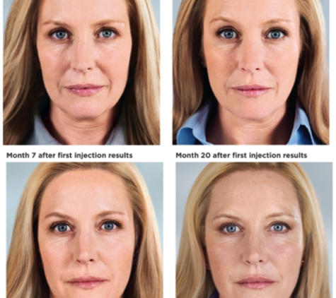 Crescent Cosmetic Surgery - Orlando, FL. Sculptra Aesthetic for Facial Volume Restoration & Rejuvenation