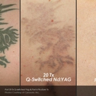 Phoenix Tattoo Removal