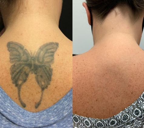 Removery Tattoo Removal & Fading - New York, NY