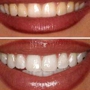 Brighter Smiles Advanced Teeth Whitening
