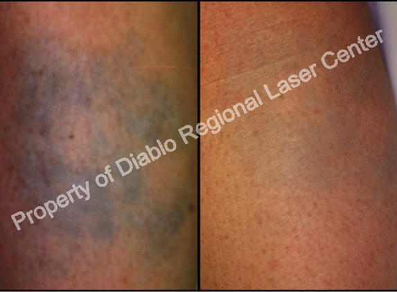 Diablo Regional Laser Center - Walnut Creek, CA