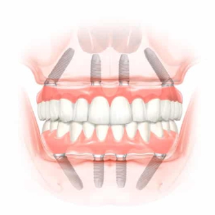 ARCHPOINT Implant Dentistry - Dallas, TX