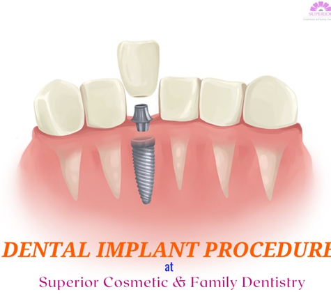 Superior Cosmetic and Family Dentistry - Bowie, MD. #dentalimplantprocedureatbowiemd #dentalimplant #fullservicedentistsbowiemd #bowiedentists #affordabledentalcarebowiemd #dentistsinbowiemd