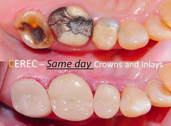 Sundial Dental Wauchope - Wauchope, NSW. Same day crowns