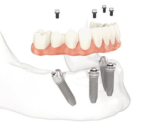 Florida Smile Studio Fort Lauderdale - Fort Lauderdale, FL