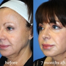 Y Lift - Physicians & Surgeons, Cosmetic Surgery