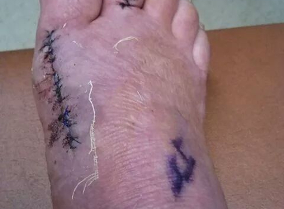 Comprehensive Foot Care - Holyoke, MA