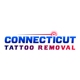 Connecticut Tattoo Removal