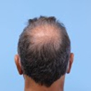 Dr Parsa Mohebi - Hair Replacement