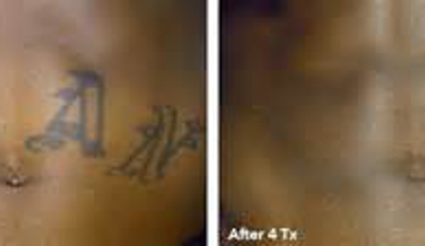 Eraser Clinic Laser Tattoo Removal - San Antonio, TX