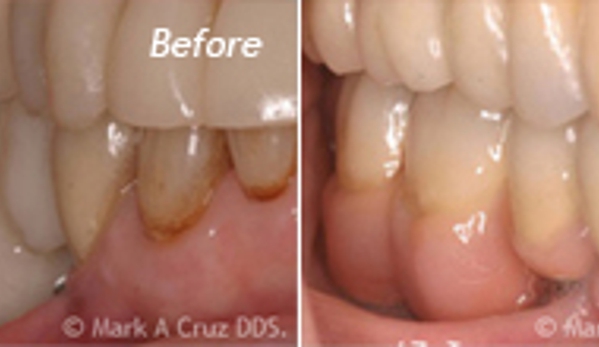 Mark A. Cruz, DDS - Dana Point, CA