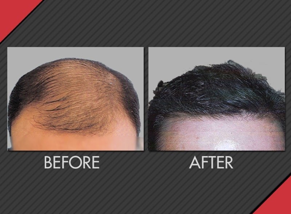 Maxim Hair Restoration - Chicago, IL