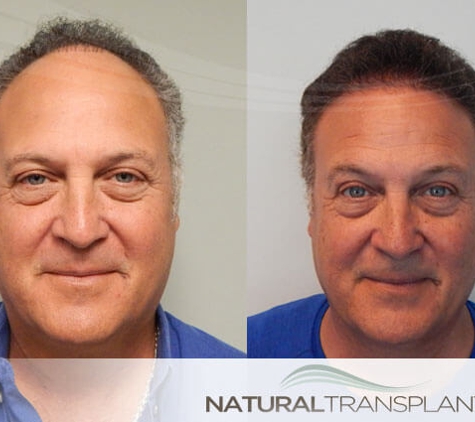 Natural Transplants, Hair Restoration Clinic - Fort Lauderdale, FL