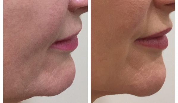 Cosmetic Laser & Skin Cancer Centre - Brendale, QLD. Before and After Non Surgical Chin Augmentation Dermal Fillers