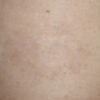 Under My Skin Tattoo Removal gallery