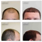 Natural Transplant, Hair Restoration Clinic