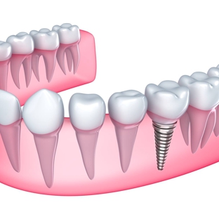 SINAI DENTAL - Van Nuys, CA. Dental Implants