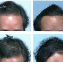 Dermatology Associates Of Atlanta PC - Hair Removal