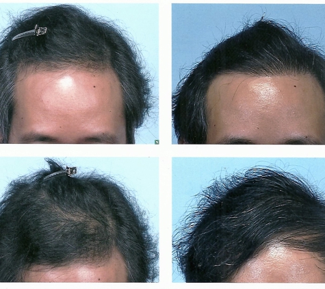 Dermatology Associates Of Atlanta PC - Atlanta, GA. Official comb-over result photos provided by the doctor.  Also notice the different angle and lighting.
left - BEFORE; right - AFTER