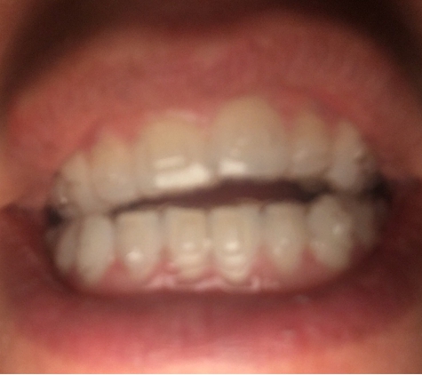 Gottlieb & Daniels Orthodontics - Cheshire, CT. Before