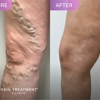 Vein Treatment Clinic | Huntington Beach gallery