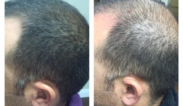 Hair Again Certified Hair Loss Specialists - San Antonio, TX