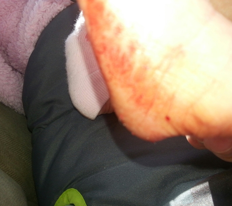 Granger Medical West Jordan - West Jordan, UT. Blood that ran down my 6 day old baby's foot and leg.