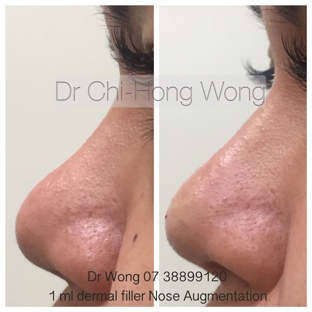 Cosmetic Laser & Skin Cancer Centre - Brendale, QLD. Before and After Non Surgical Nose Augmentation using Fillers