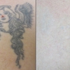 Vanish Laser Tattoo Removal and Skin Aesthetics gallery
