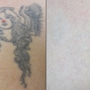Vanish Laser Tattoo Removal and Skin Aesthetics