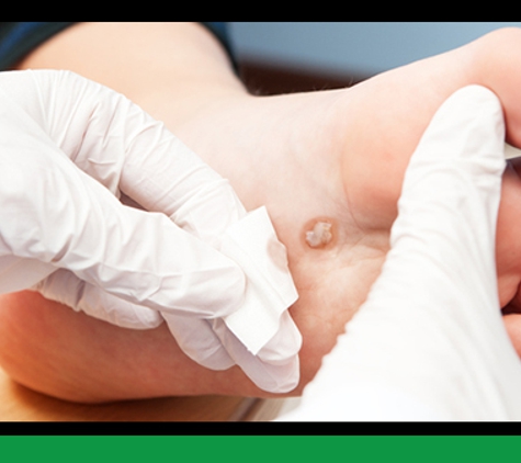 The Foot and Ankle Clinic - Traralgon, VIC. Wart Treatments