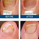 Toenail Fungus Removal Pasadena -- Laser Nail Therapy Clinic - Physicians & Surgeons, Laser Surgery