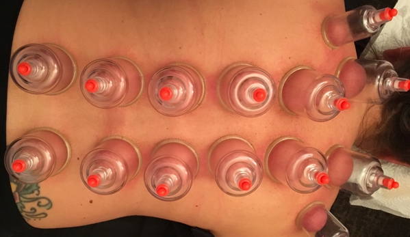 Chiropractic Family Health Center - Centreville, VA. Cool#cupping ! Try it out ! Phenomenal !