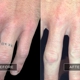 Removery Tattoo Removal & Fading