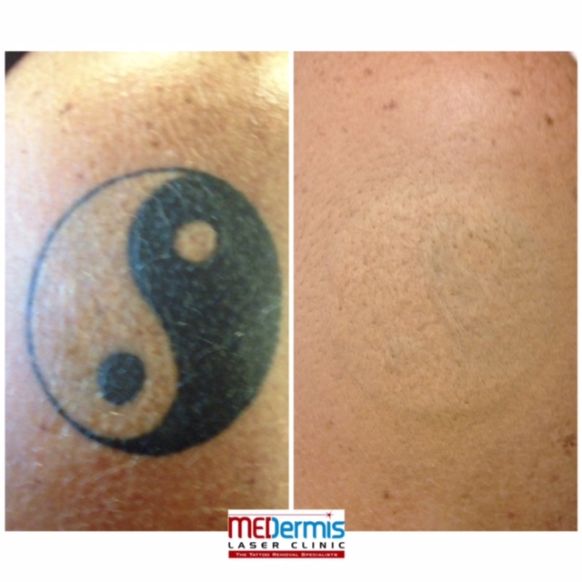 MEDermis Tattoo Removal 2111 Dickson Dr, Ste 20, Austin