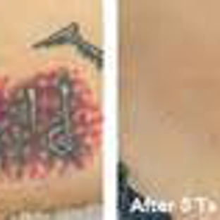 Eraser Clinic Laser Tattoo Removal - San Antonio, TX