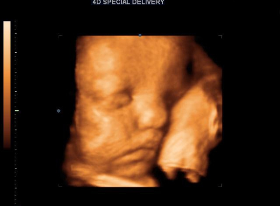 3D 4D Ultrasound by 4D Special Delivery - Upland, CA