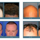 Complete Hair Restoration