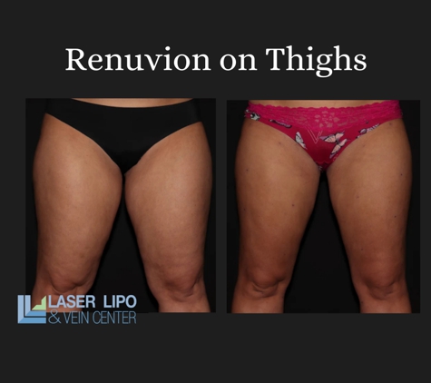 Laser Lipo and Vein Center - O Fallon, MO