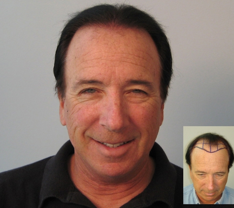 Natural Hair Transplant Medical Center - Newport Beach, CA